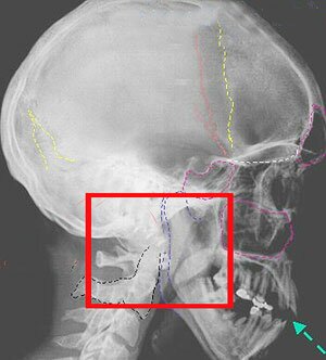 перелом основания черепа