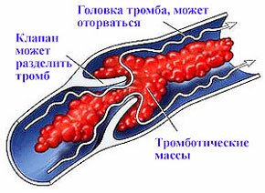 эмболия легочной артерии